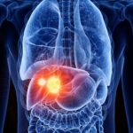 Liver cancer
