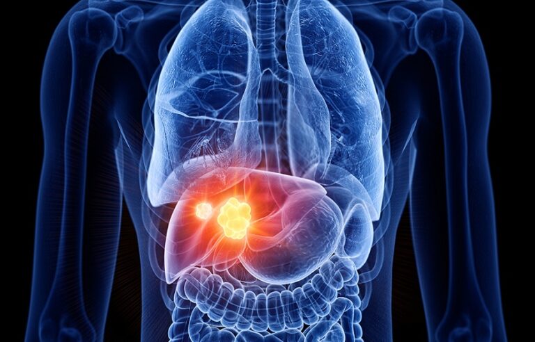 Liver cancer