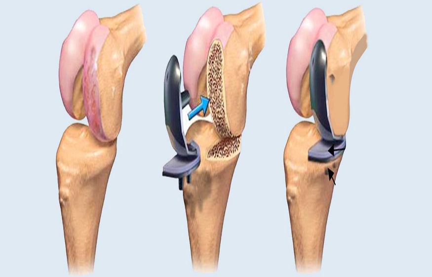 replacement surgery