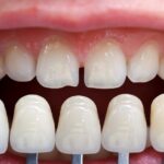 veneer