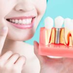 Understanding Dental Implants