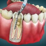 How Root Canals Improve Long-Term Oral Health and Comfort