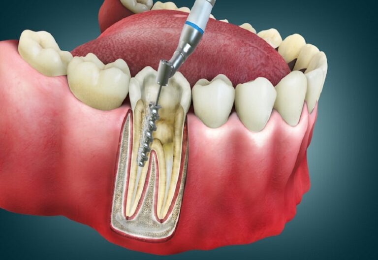 How Root Canals Improve Long-Term Oral Health and Comfort