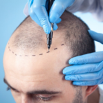 best hair transplant techniques