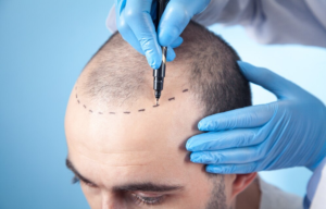 best hair transplant techniques